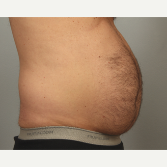 56 year old man with localized lipodystrophy in the abdominal and flank region. before 3449016