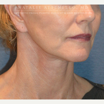 Before and After a Facelift after 3613824