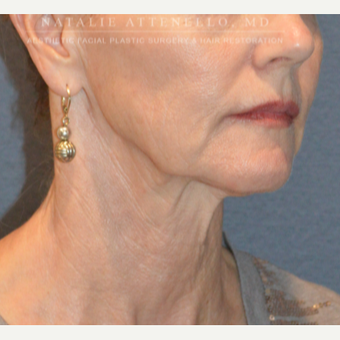 Before and After a Facelift before 3613824