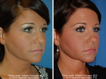 Neck Liposuction before 1389503