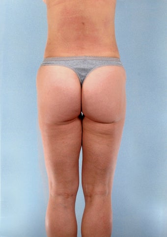 Liposuction of the Outer Thighs / Saddlebags 1219733