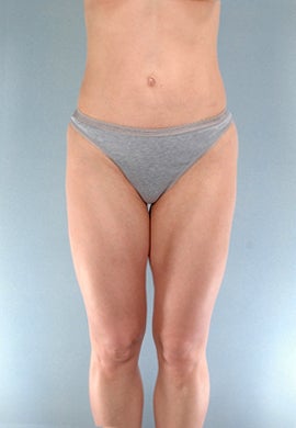 Liposuction of the Outer Thighs / Saddlebags after 1219733