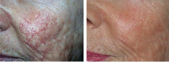 IPL Treatment before 1340178