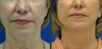 Facelift before 246954
