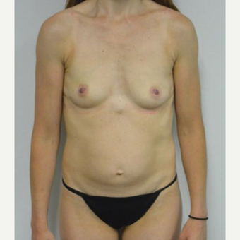 35-44 year old woman treated with Mommy Makeover before 3282969