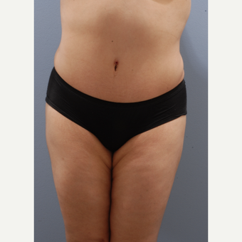 25-34 year old woman treated with Tummy Tuck after 3590386