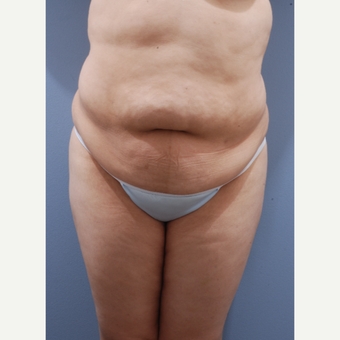 25-34 year old woman treated with Tummy Tuck before 3590386
