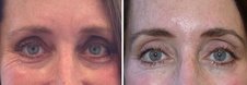 Before and after Botox Brow Lift before 1094079