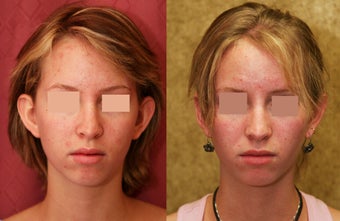 ear surgery or otoplasty before and after pictures before 1010474