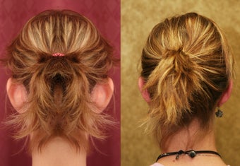 ear surgery or otoplasty before and after pictures after 1010474