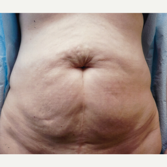 45-54 year old woman treated with Tummy Tuck before 3458327