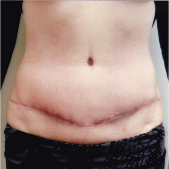 45-54 year old woman treated with Tummy Tuck after 3458327