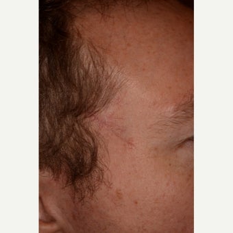 35-44 year old man treated with Mohs Surgery after 1693197