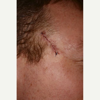 35-44 year old man treated with Mohs Surgery before 1693197