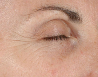 Ultherapy before 460620