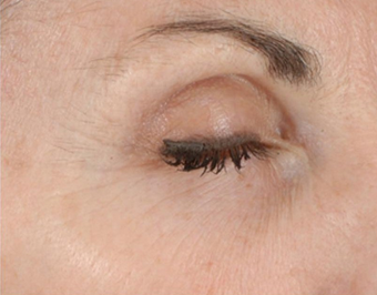 Ultherapy after 460620