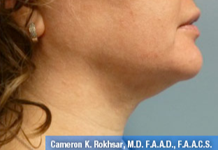 35-44 year old woman treated with Liposuction after 2976028