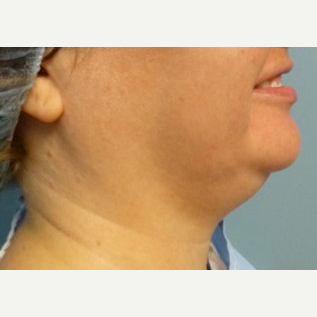 35-44 year old woman treated with Liposuction before 2976028