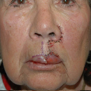 Mohs Surgery after 3711229