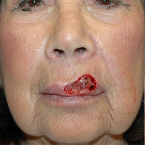 Mohs Surgery before 3711229