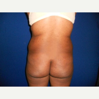 35-44 year old woman treated with Fat Transfer before 1567209