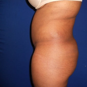 35-44 year old woman treated with Fat Transfer 1567209