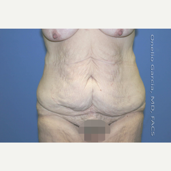 45-54 year old woman treated with Body Lift-Circumferential "Belt" lipectomy + Vaser Liposuction before 3041534