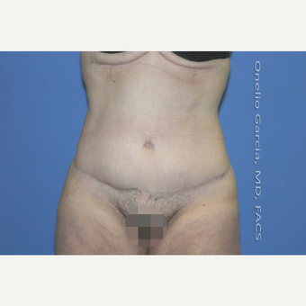 45-54 year old woman treated with Body Lift-Circumferential "Belt" lipectomy + Vaser Liposuction after 3041534