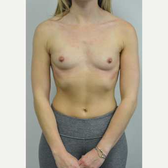 25-34 year old woman treated with Breast Implants who wants a natural look before 3644560