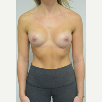 25-34 year old woman treated with Breast Implants who wants a natural look after 3644560