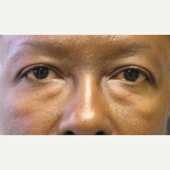 45-54 year old woman treated with Eye Bags Treatment before 1905691