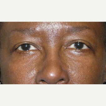 45-54 year old woman treated with Eye Bags Treatment after 1905691