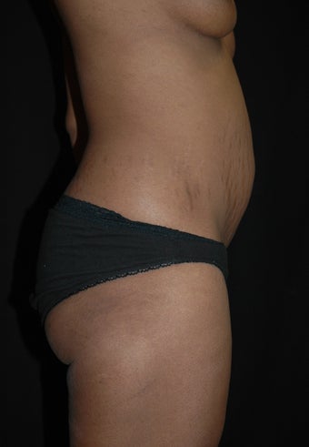 Abdominoplasty/Tummy Tuck before 653448