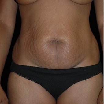 Abdominoplasty/Tummy Tuck 653448