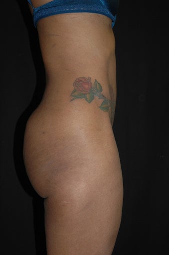 Abdominoplasty/Tummy Tuck after 653448