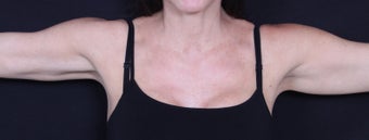 Female patient treated for CoolSculpting of the Arms before 1135198