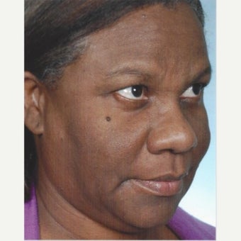 35-44 year old woman treated with Melasma Treatment with Obagi Nu Derm Skin Transformation System before 2581702