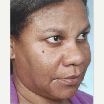 35-44 year old woman treated with Melasma Treatment with Obagi Nu Derm Skin Transformation System after 2581702