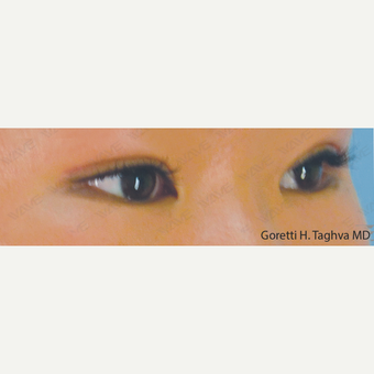 18-24 year old woman treated with Asian Eyelid Surgery after 3347019