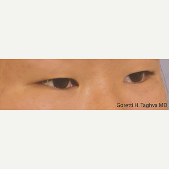 18-24 year old woman treated with Asian Eyelid Surgery before 3347019