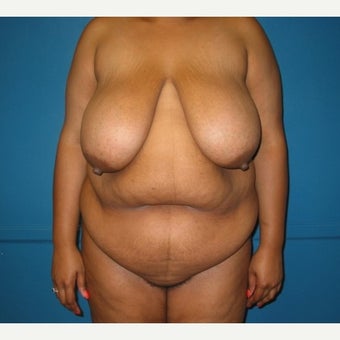 Body lift on 32 year old female. A breast reduction, tummy tuck, and lipostuction were performed in a single operation before 1810310