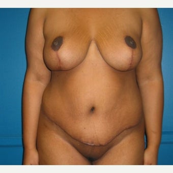 Body lift on 32 year old female. A breast reduction, tummy tuck, and lipostuction were performed in a single operation after 1810310