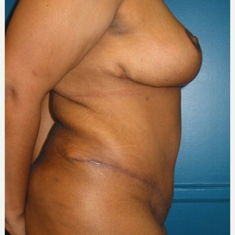 Body lift on 32 year old female. A breast reduction, tummy tuck, and lipostuction were performed in a single operation 1810310