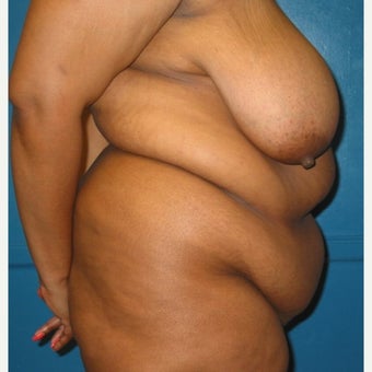 Body lift on 32 year old female. A breast reduction, tummy tuck, and lipostuction were performed in a single operation 1810310