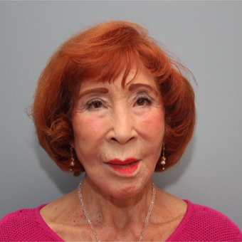 83 year old woman treated with Fat Transfer to the Pre-Jowls after 3544480