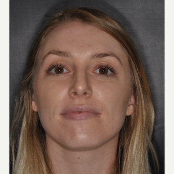 18-24 year old woman treated with Septoplasty 1 year post-op after 3499795
