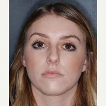 18-24 year old woman treated with Septoplasty 1 year post-op before 3499795