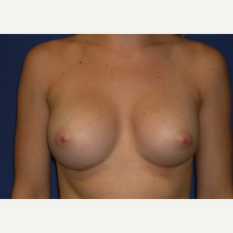 25-34 year old woman treated with Breast Augmentation after 3220054