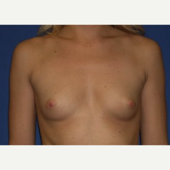 25-34 year old woman treated with Breast Augmentation before 3220054