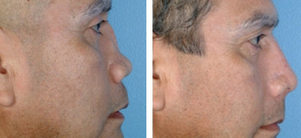 Revision Rhinoplasty before 1208277